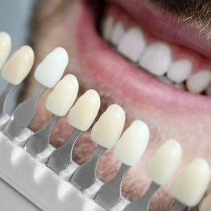 Mastering the Smile: The Journey to Perfection with Porcelain Veneers