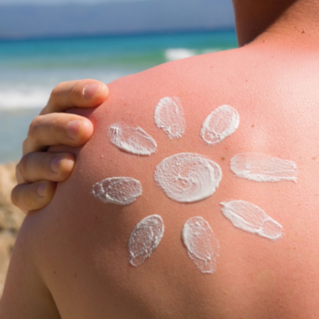 6 Sunburn Prevention Tips: Save Your Skin This Summer