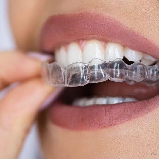 Clear Aligners