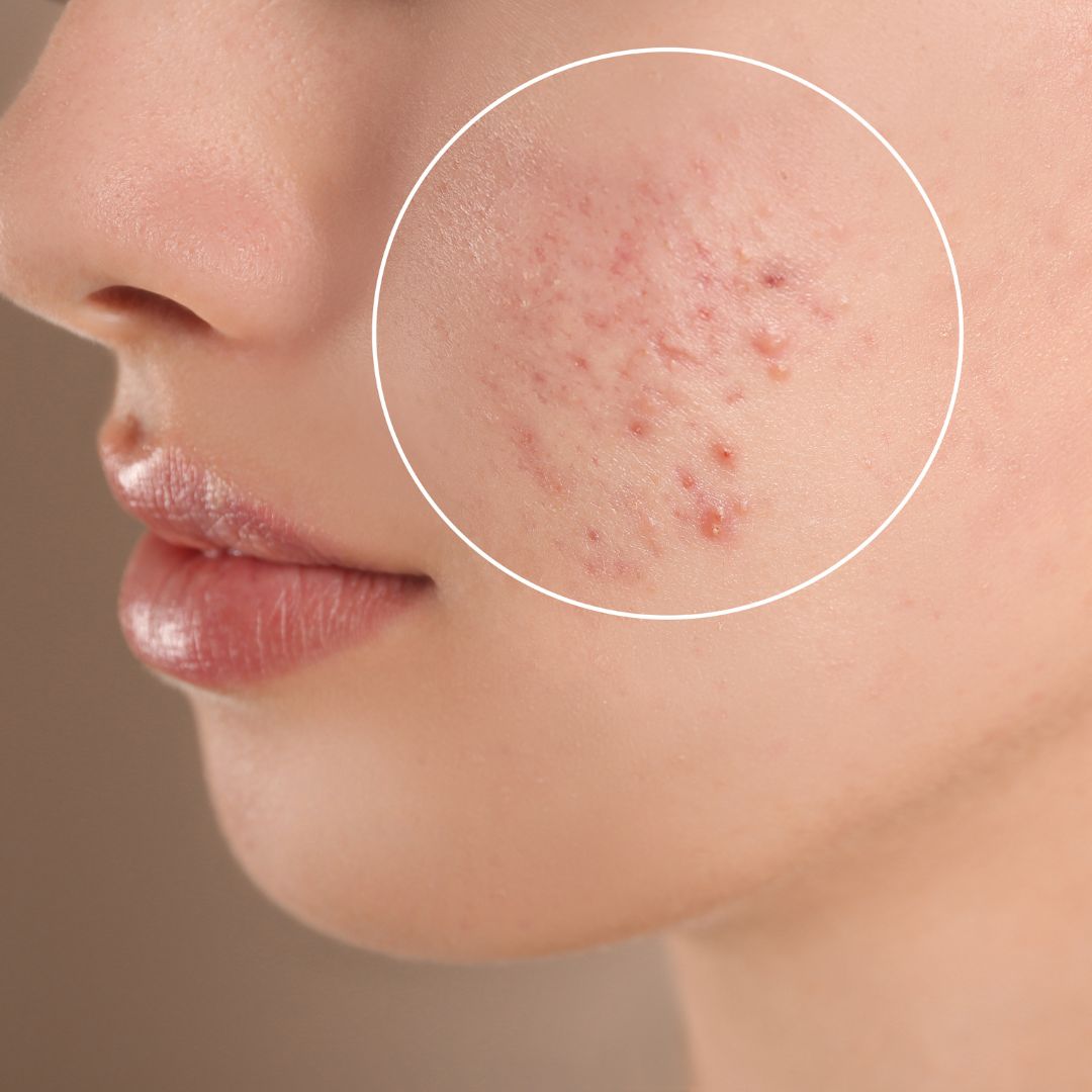 Comedonal Acne