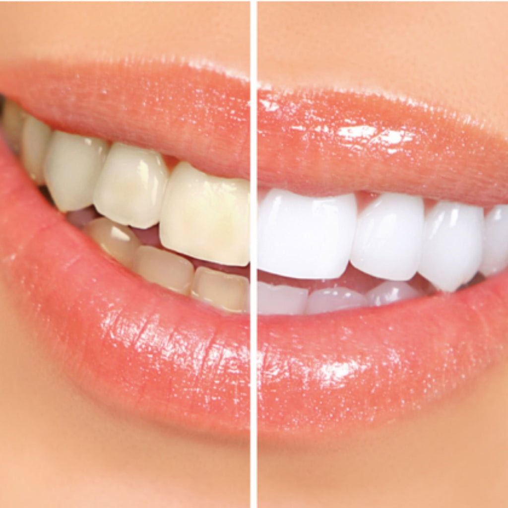 DIY Teeth Whitening: 5 Brilliant Tips for Whiter Teeth That Work