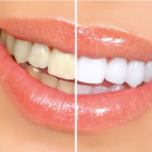 DIY Teeth Whitening: 5 Brilliant Tips for Whiter Teeth That Work
