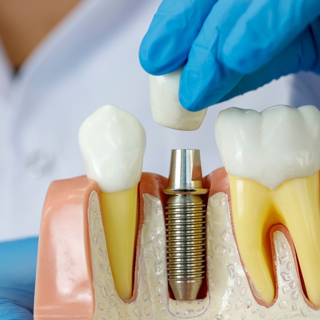 How Much Does A Dental Implant Cost For One Tooth?