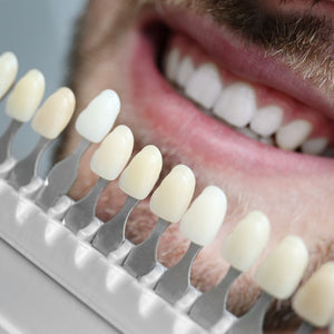 How to Make Your Dental Veneers Last for a Long Time