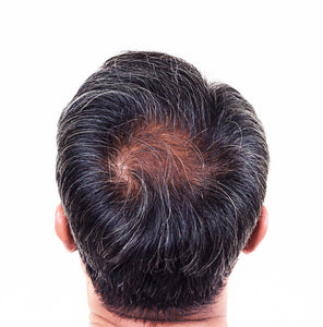 Which Hair Growth Treatment is Right For You