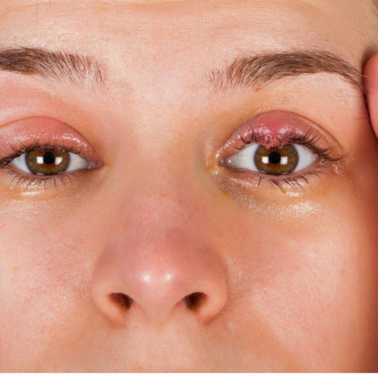 Eyelid Ointment