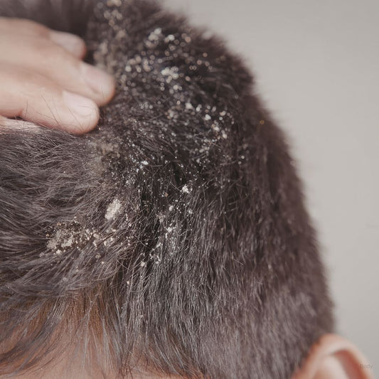 Flaky Scalp