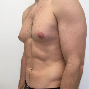 Top 10 FAQs Related to Gynecomastia