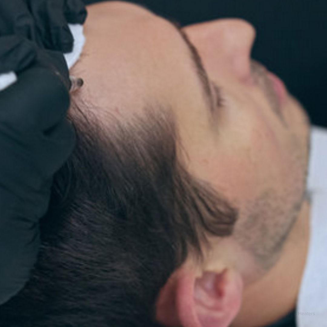 The Magic of Hair Restoration: Top Scalp Micropigmentation in Los Angeles