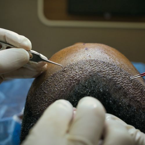 Hair Transplant Experience: What to Expect Before, During, and After