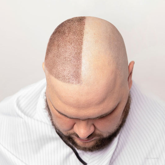 Hair Transplant