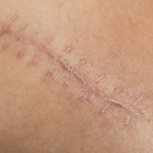 How to Get Rid of Scars: 5 Proven Treatments