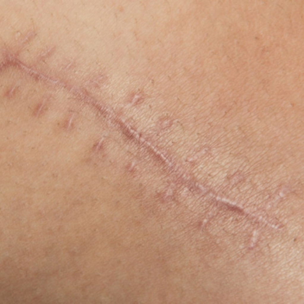 How to Get Rid of Scars: 5 Proven Treatments