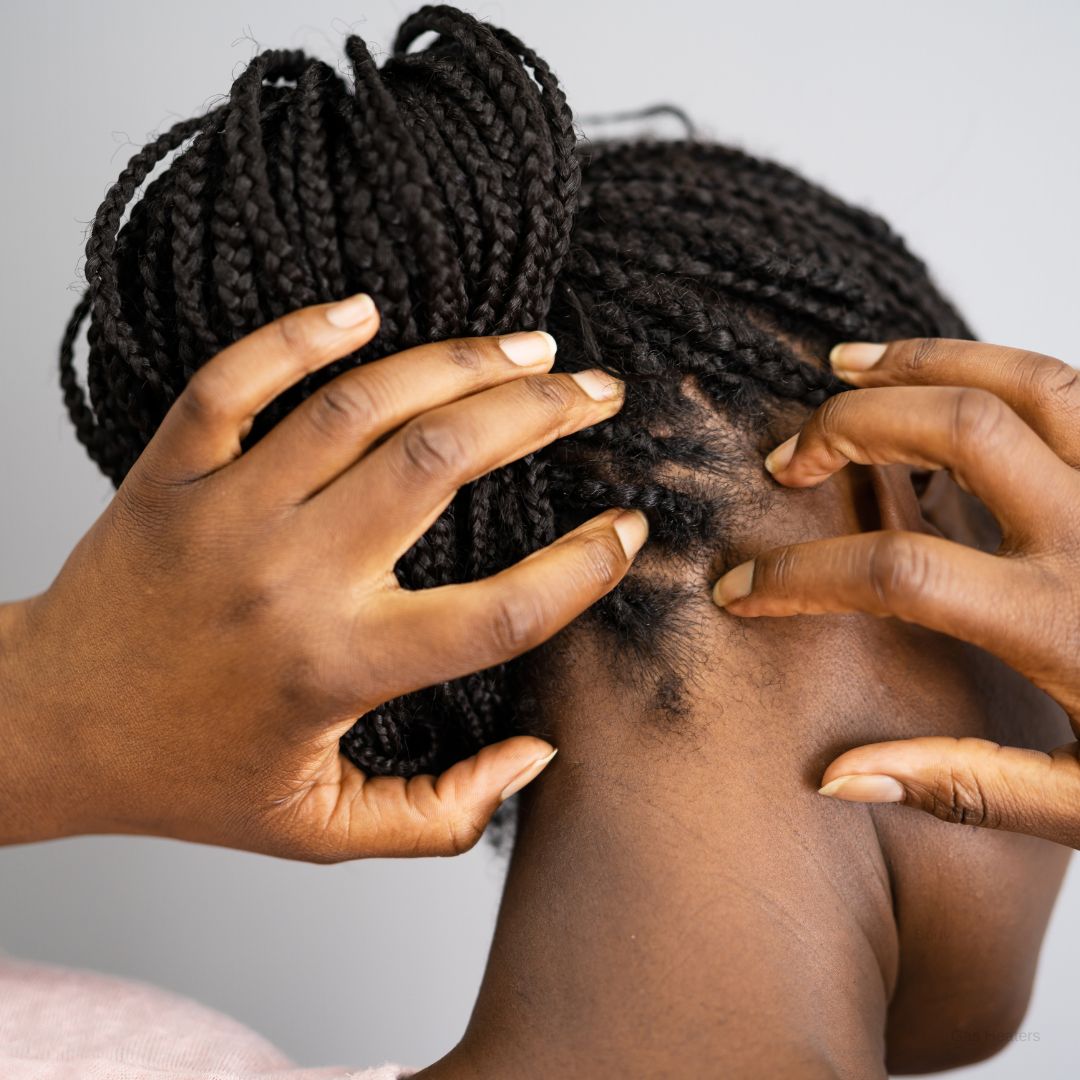 Itchy Scalp at Night? Reasons & How a Silk Pillowcase Helps