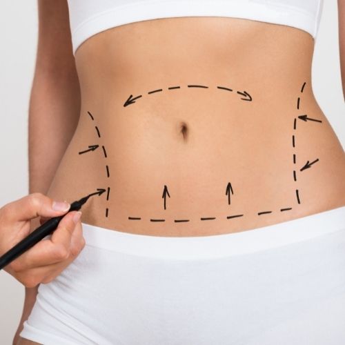 How Long to Recover from Liposuction