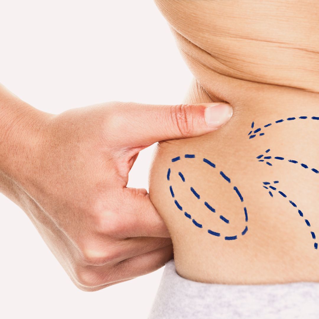 Shaping Your Body: The Basics of Liposuction