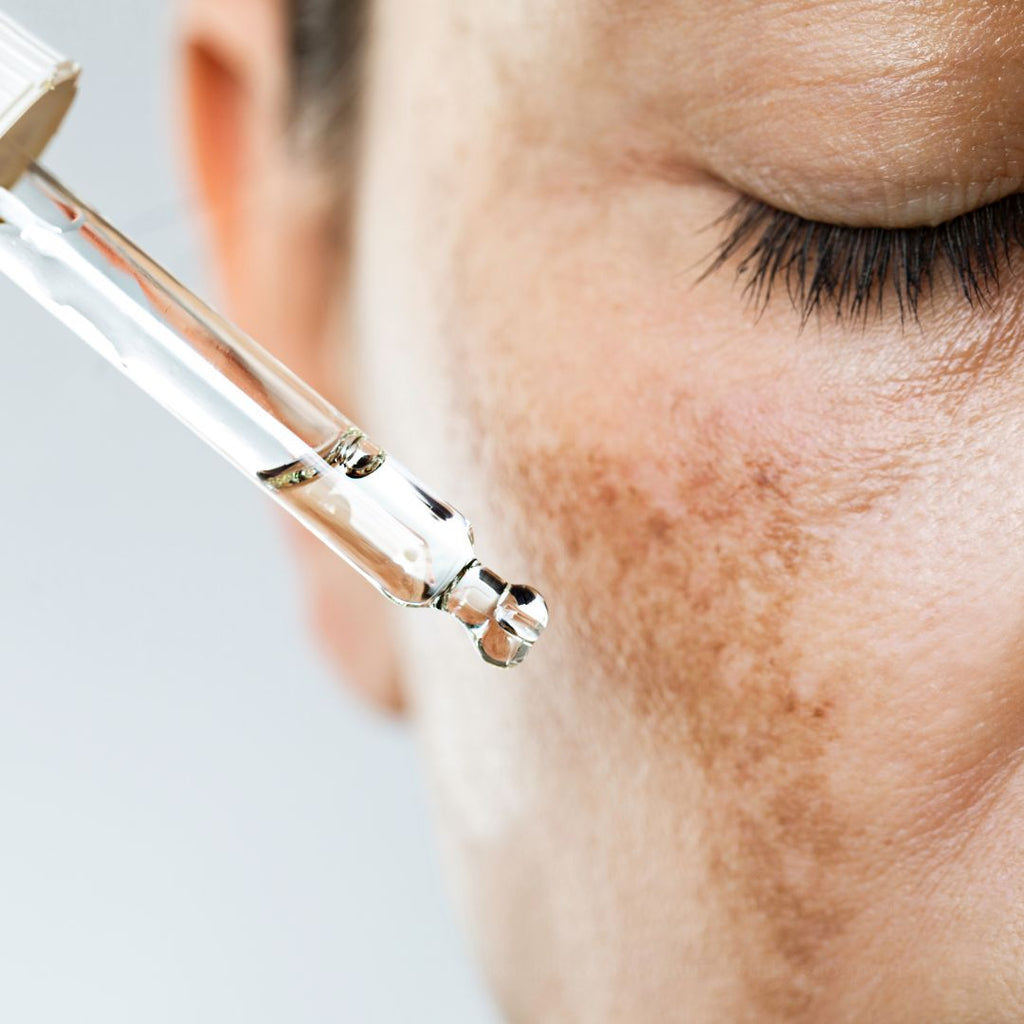 What you need to Know about Top Melasma Treatment Options: Expert Insights