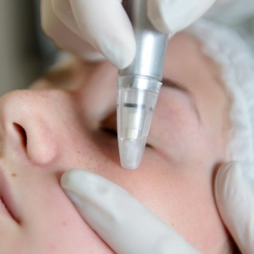 Microdermabrasion For Clogged Pores