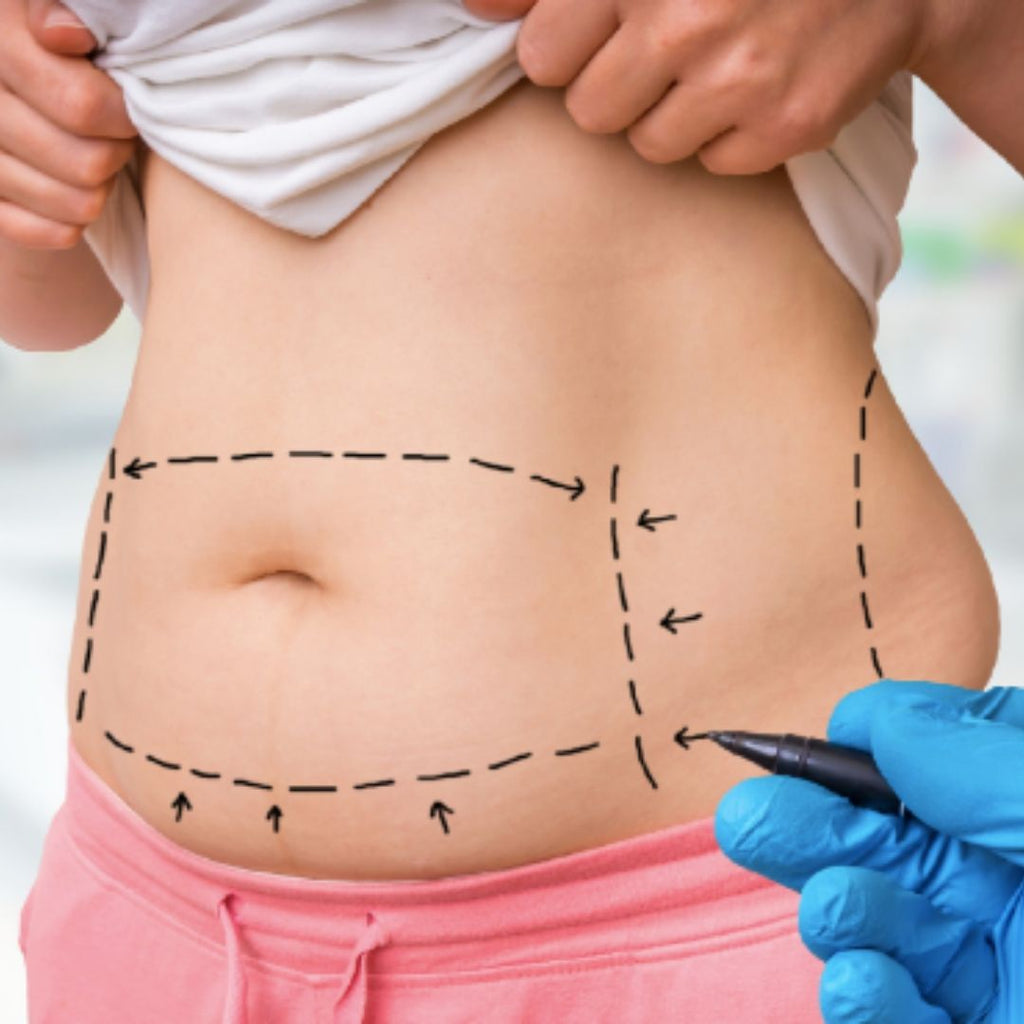 Recovering from Lipo What to Expect With Liposuction Recovery