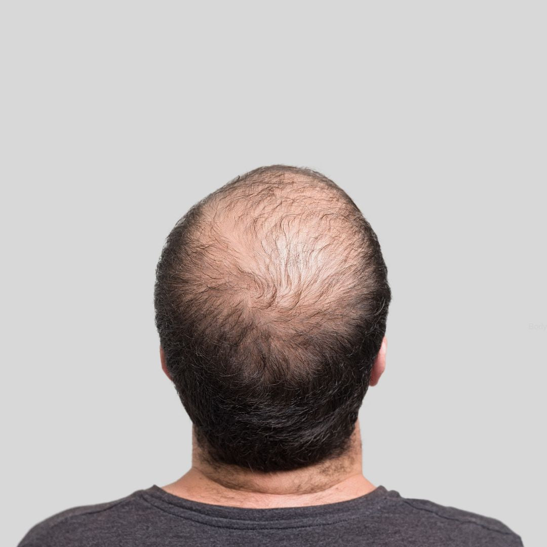 Reverse Balding