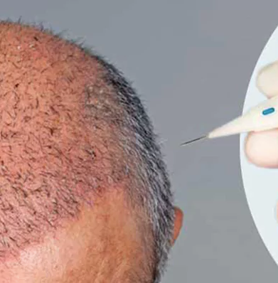 Hair Transplant