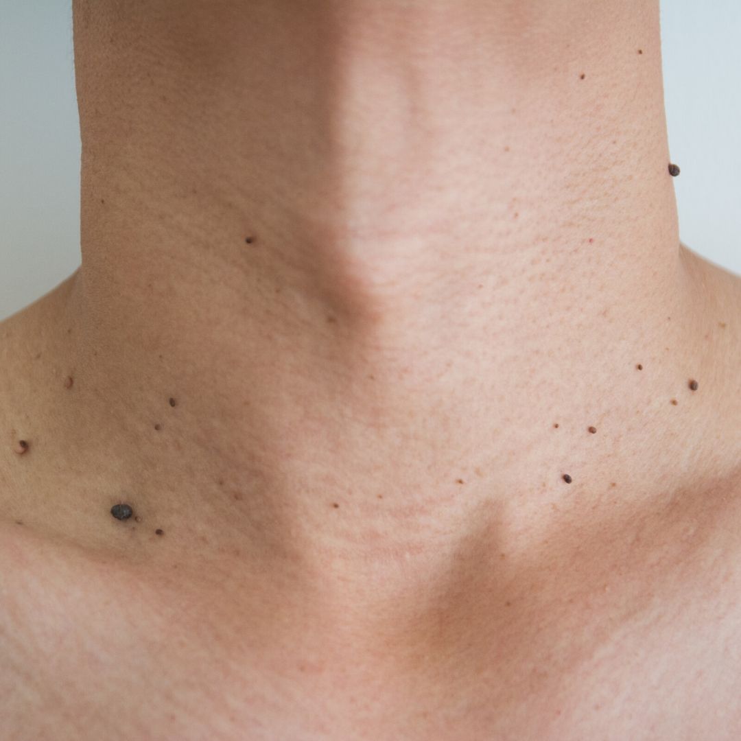 What Causes Moles On Your Skin?