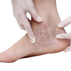 Myths Not To Be Believed About Varicose Veins