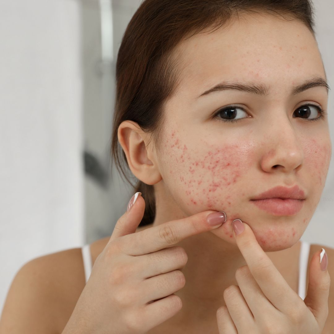 acne-prone skin