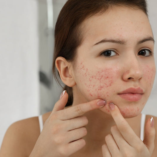 acne-prone skin