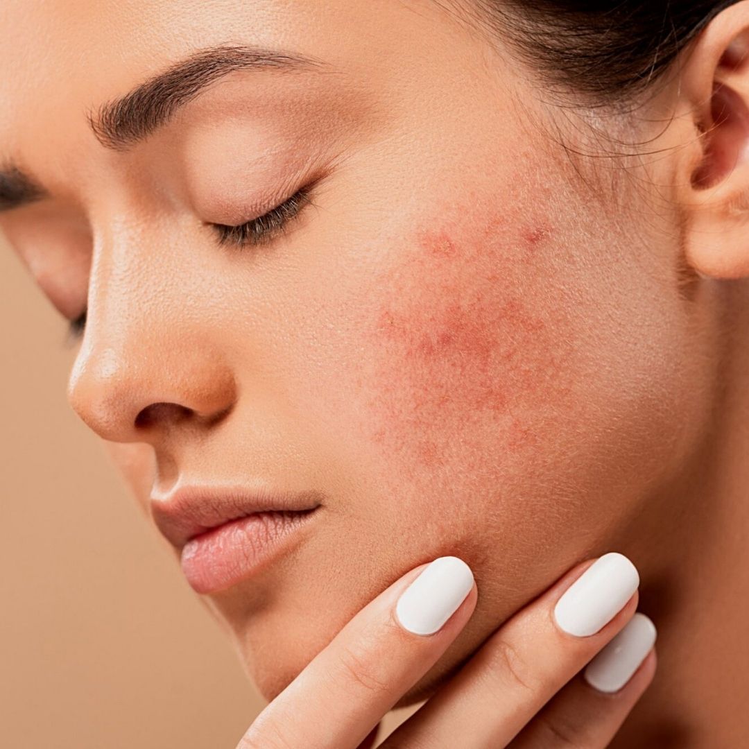 Why Am I Spotty After Using the Best Acne Spot Treatment?