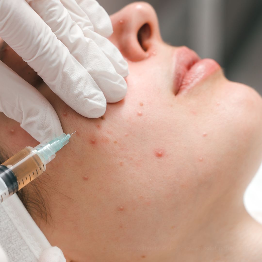 Acne Treatment Singapore: Is there a Permanent Cure for Acne?