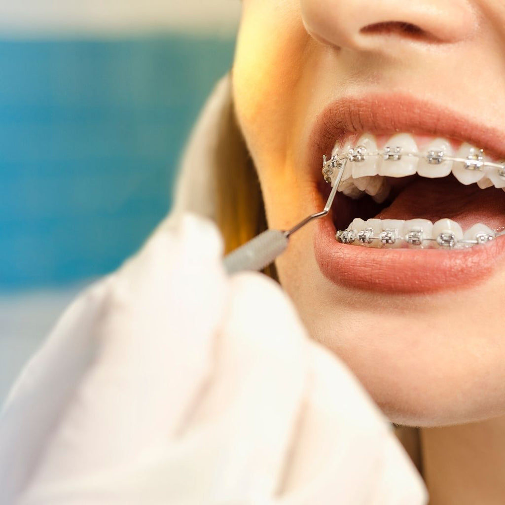 What is the Difference Between Invisalign and Aligners?