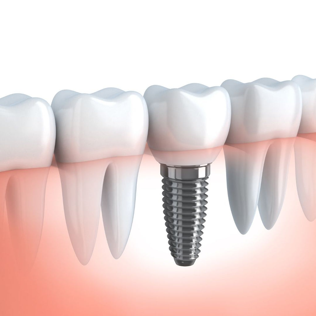 Types Of Dental Implants: How To Choose The Best One for You?