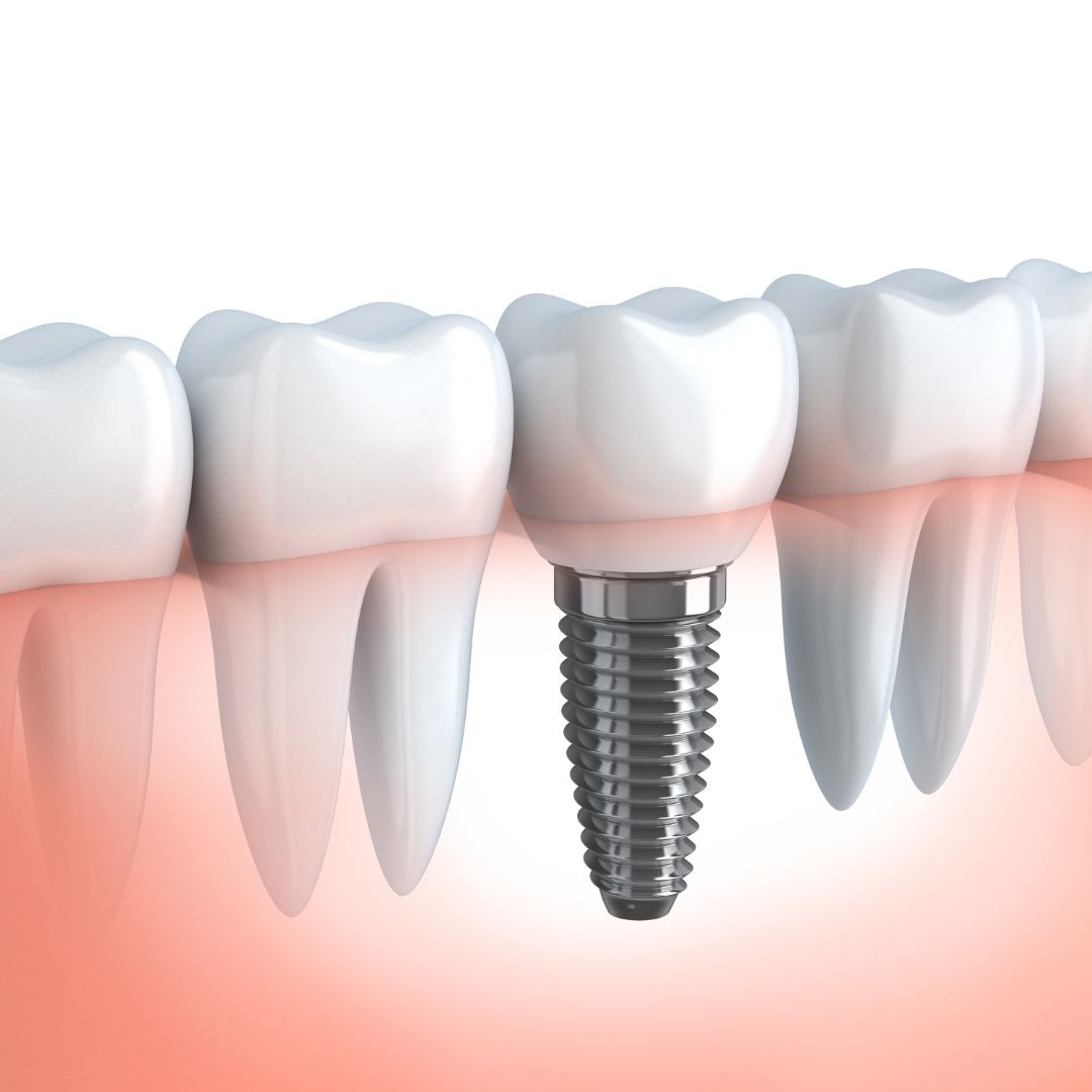 Types Of Dental Implants: How To Choose The Best One for You?