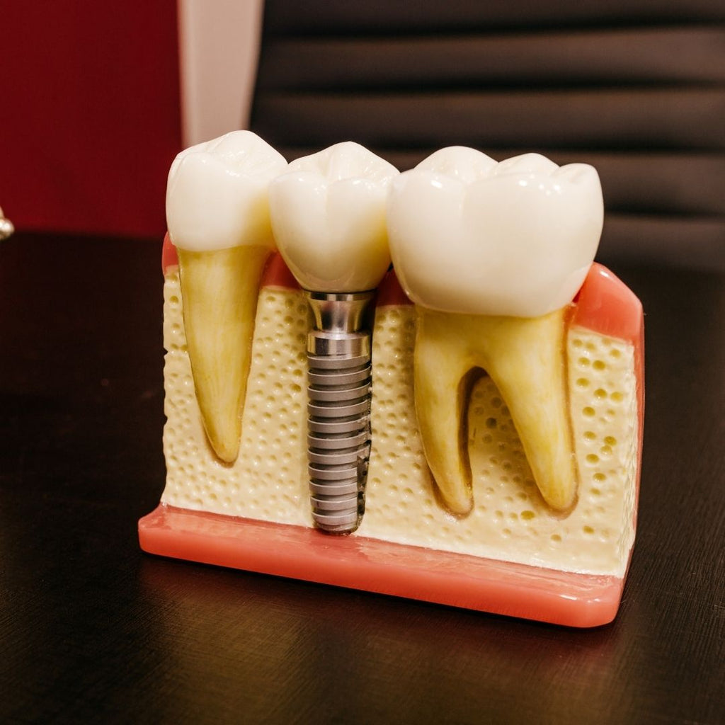 KEY FACTS ABOUT DENTAL IMPLANT PROCEDURES IN TARZANA