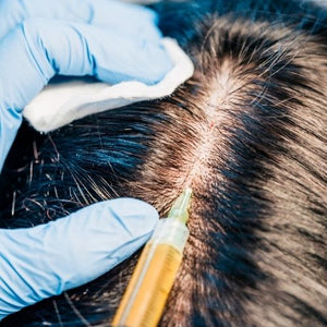 Are Hair Implants a Viable Solution for Men with Hair Loss?