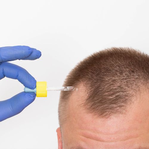 Hair Restoration & How It Became A Popular Aesthetic Treatment