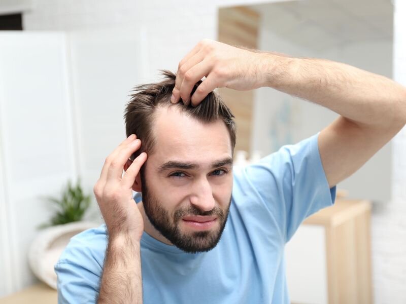  Causes of Hair Loss in Men